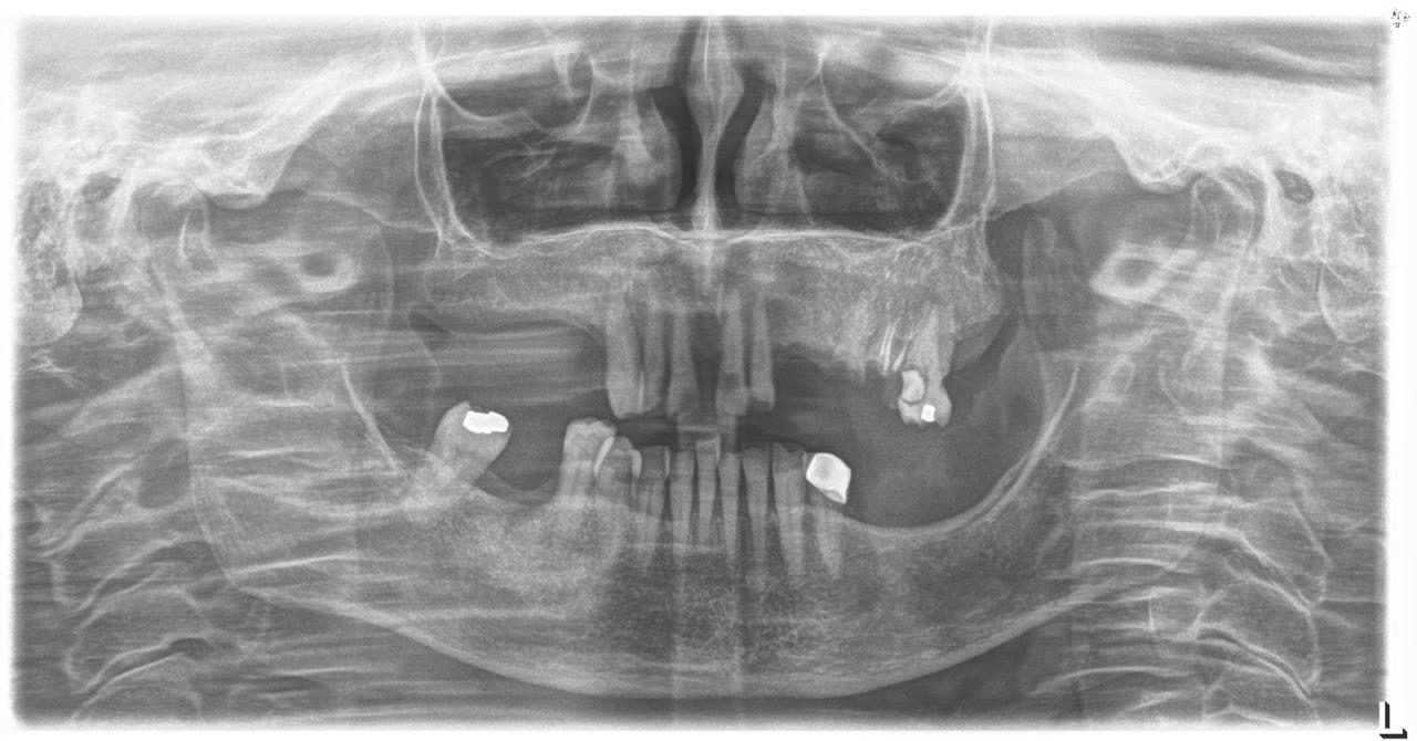 Sirona Orthophos XG 3 – Aparat Radiografik Panoramik Dixhital - Miniaturë 7